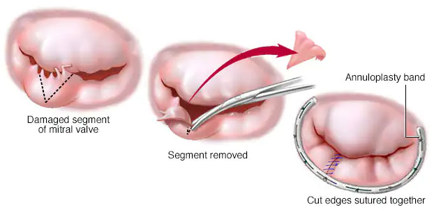 نارسایی دریچه میترال-2