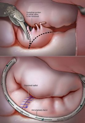 نارسایی دریچه میترال-3