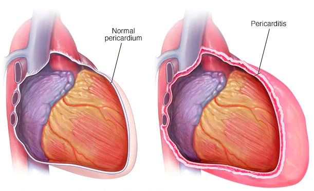پریکاردیت-1