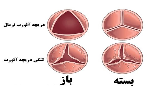 تنگی دریچه آئورت-1