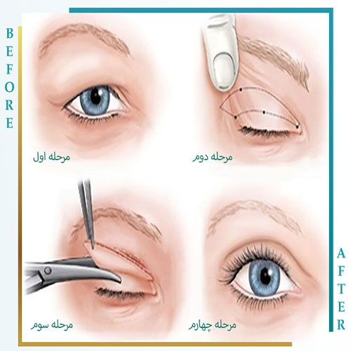 ست بلفاروپلاستی